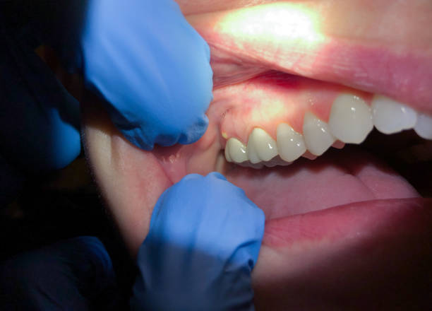 Best Emergency Root Canal Treatment in Nevada City, CA