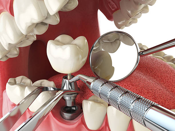 Best Emergency Tooth Extraction in Nevada City, CA